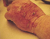 Hank Hassen's hand two days after application