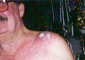 (After years of removing numerous cancers)... just a small scar on chest and shoulder remains - May, 2001
