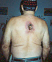 Skin cancer, back, taken April 21, 1995