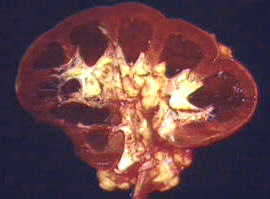 Cut section of a normal kidney. The outer part is the cortex,
 normally measuring about 0.5 cm in thickness.  The cortex consists of the renal corpuscles, the straight and convuluted tubular segments of the kidney nephron, the collecting tubules and an extensive vascular supply.  The medulla is the darker triangular segment consisting of straight segments of the tubules, collecting ducts, and a capillary network called the vasa recta.
