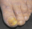 Nail fungus