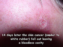 ... 14 days later the skin cancer (similar to white rubber)fell out leaving a bloodless cavity