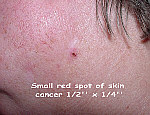 Small red spot of skin, cancer: 1/2' x 1/4'